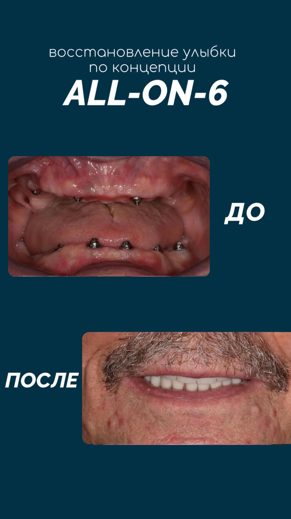 Профессиональная чистка