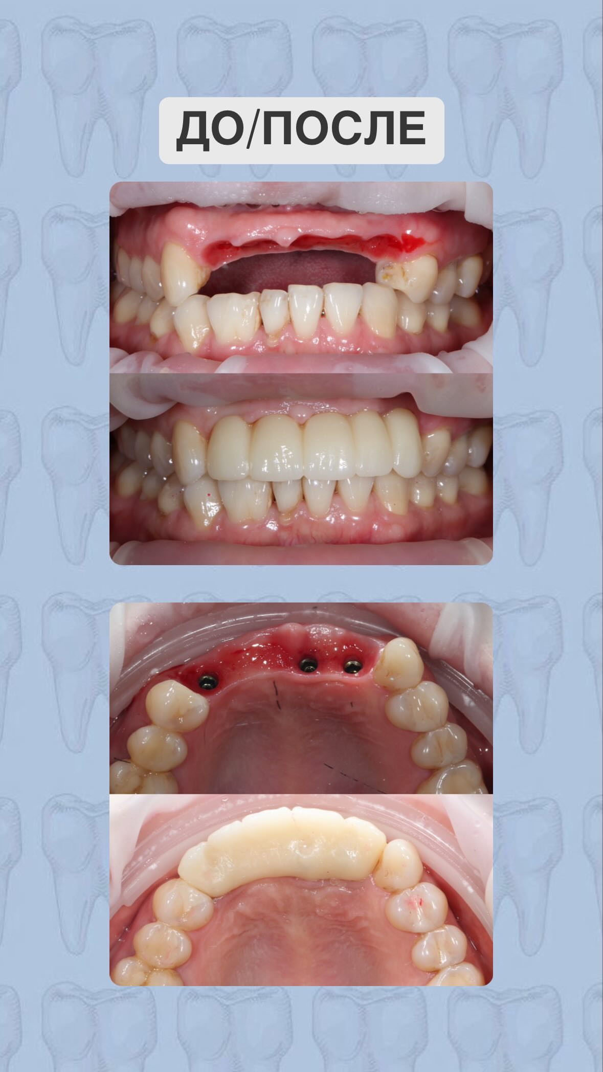 Капы от бруксизма