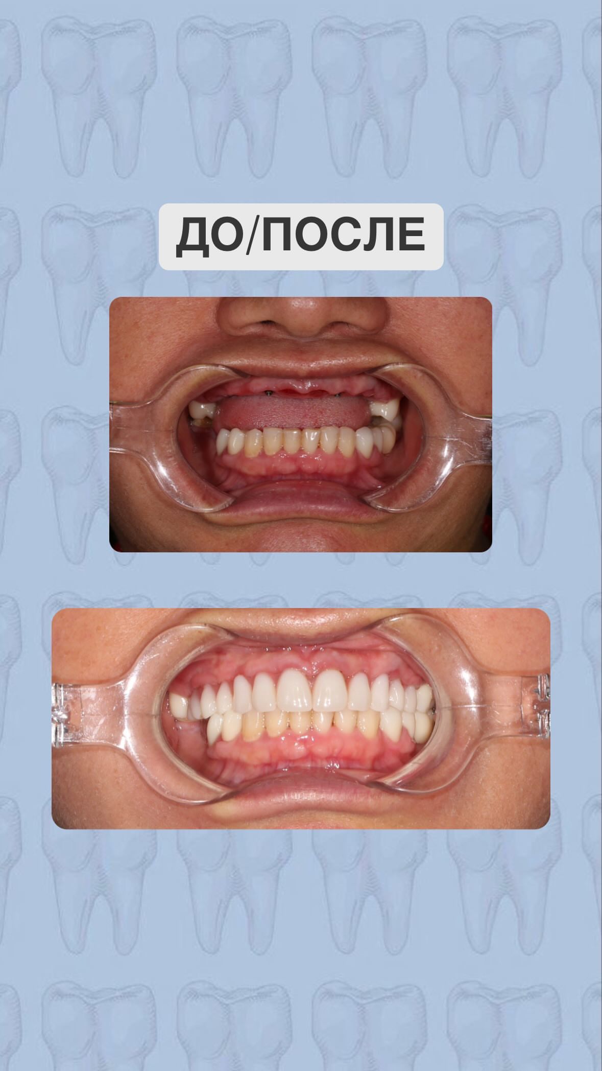 Результат лечения до/после