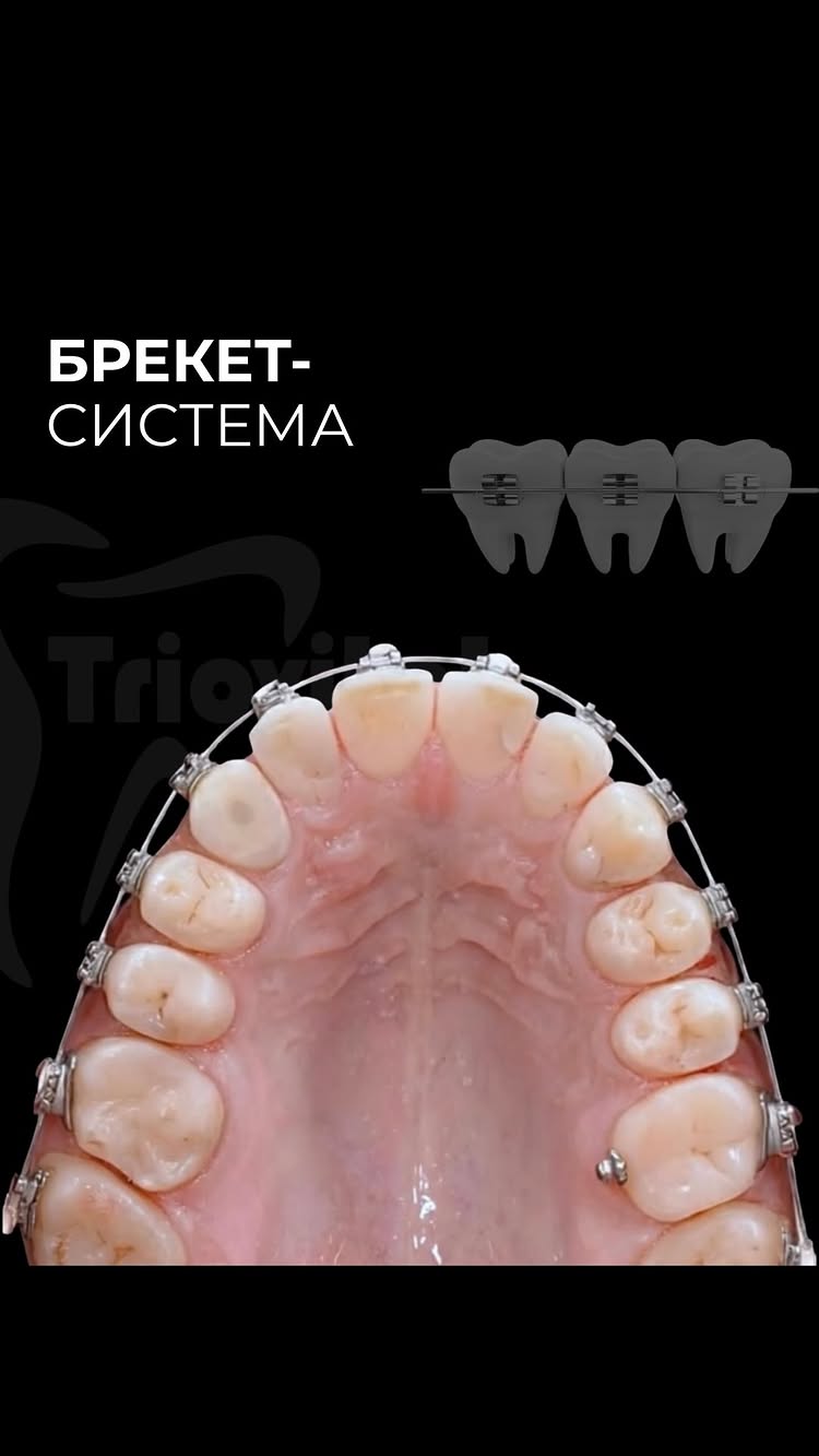 Брекет-системы