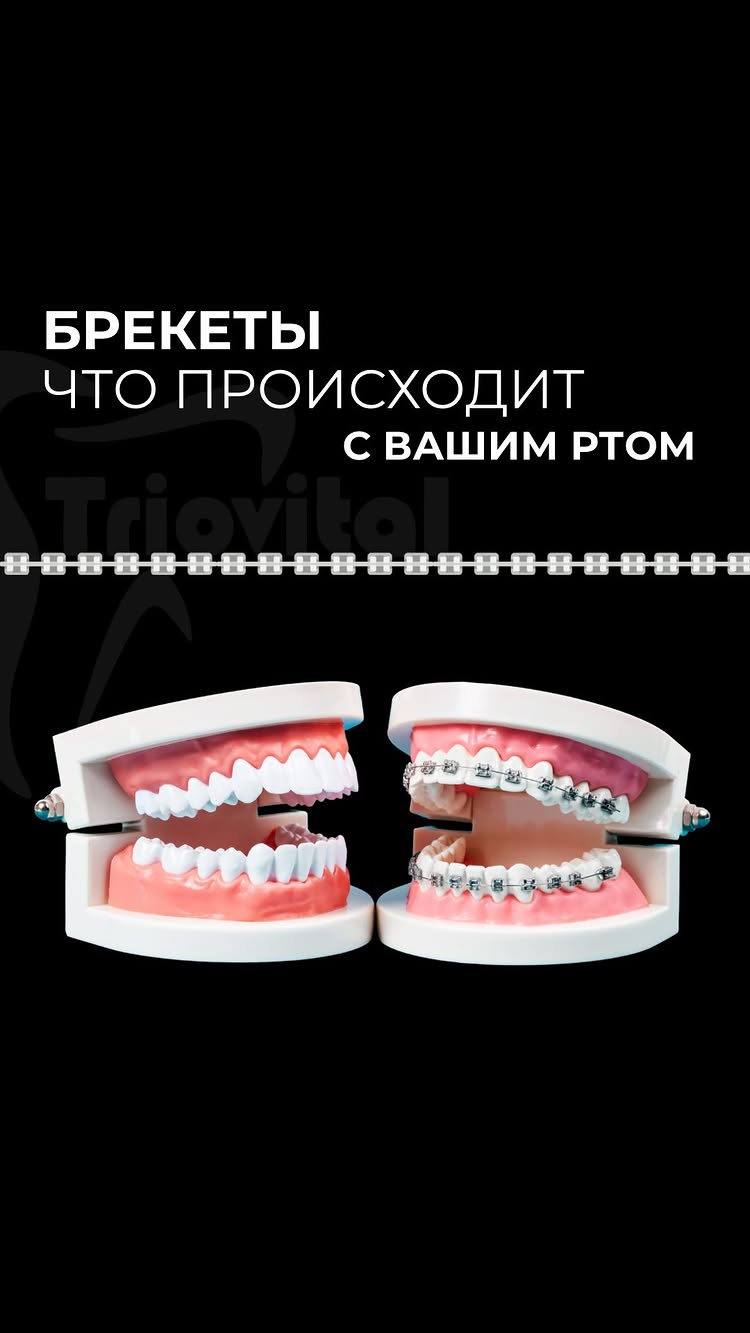 Брекет-системы